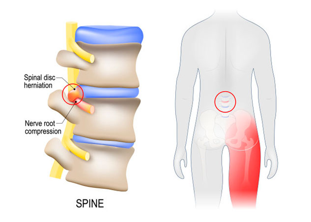 Sciatica. scheme with vertebrae, disks and nerves.