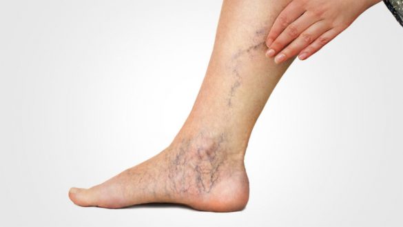 Leg with varicose vein