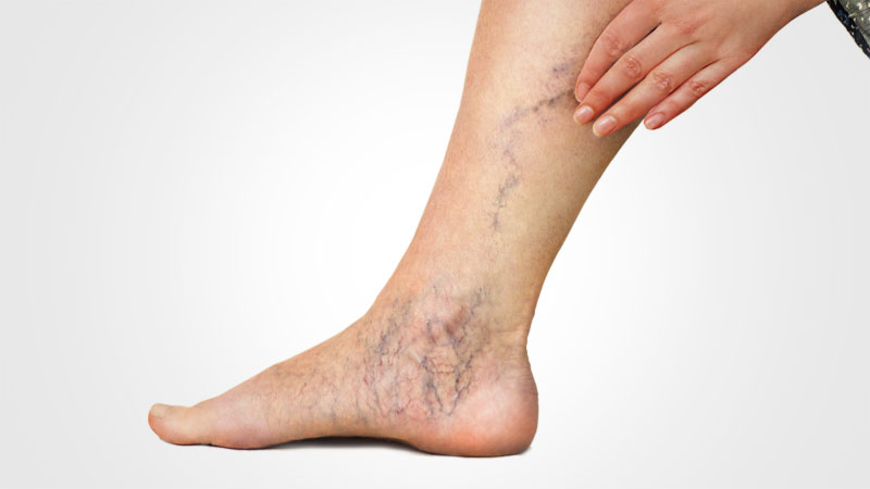 Varicose veins – main symptoms and treatments