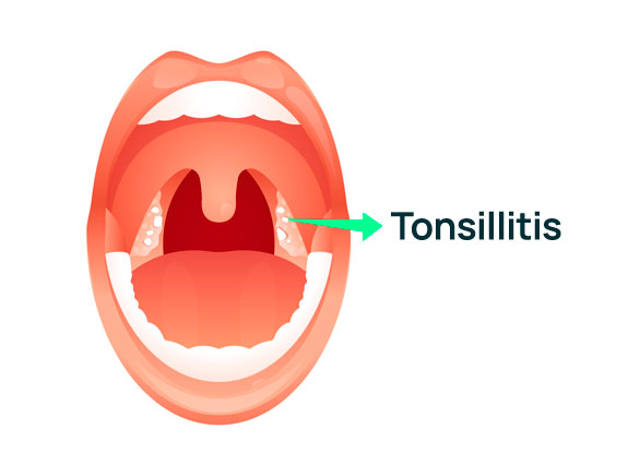 What Is Tonsillitis